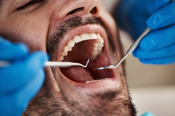 Emergency Dental Filling Replacement in NE