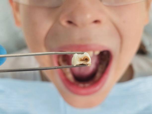 Best Cracked Tooth Emergency Dentist  in West Point, NE